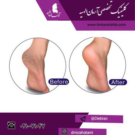 علت و درمان ترک خوردن پوست کف پا