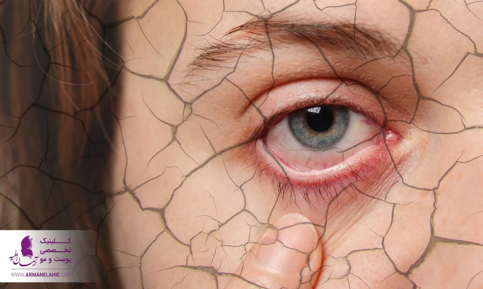11 روش درمان خشکی چشم در طب سنتی