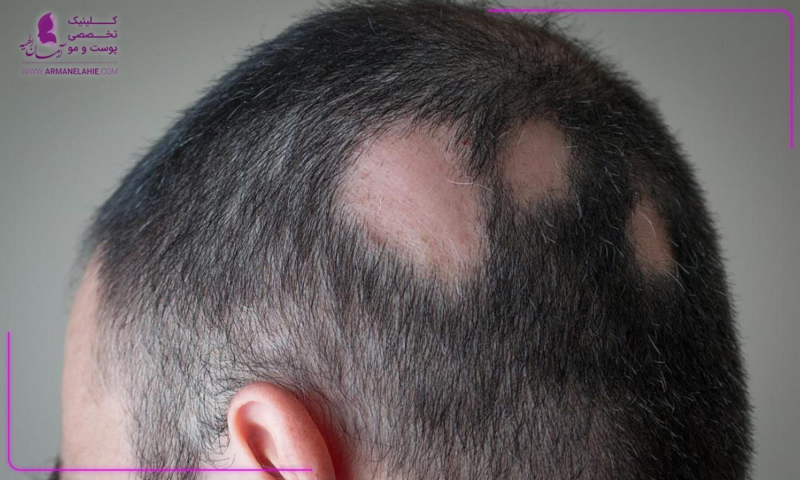 روش های خانگی برای درمان ریزش مو سکه ای   