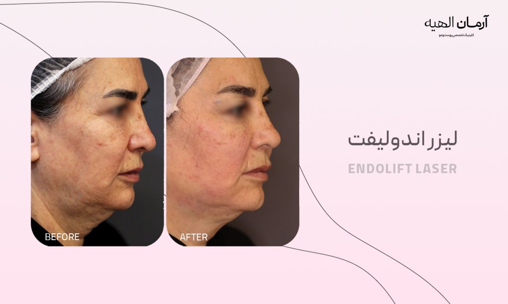 لیفت و جوانسازی صورت با لیزر اندولیفت
در کلینیک تخصصی آرمان الهیه
