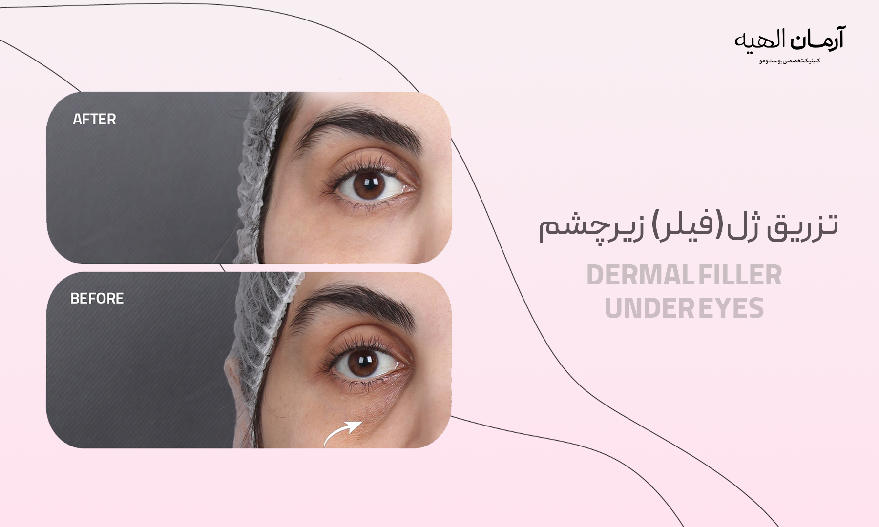 تزریق ژل زیر چشم