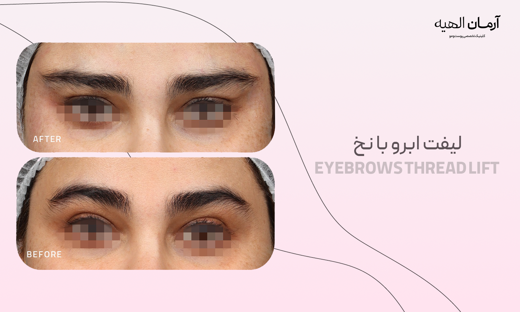 لیفت ابرو با نخ