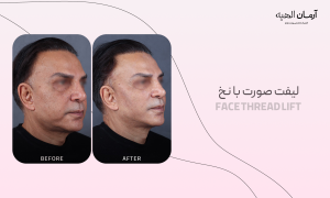 لیفت صورت با نخ با تکنیک انحصاری کلینیک تخصصی آرمان الهیه