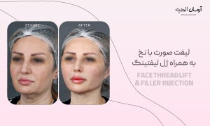 لیفت صورت و غبغب با نخ کلینیک تخصصی آرمان الهیه