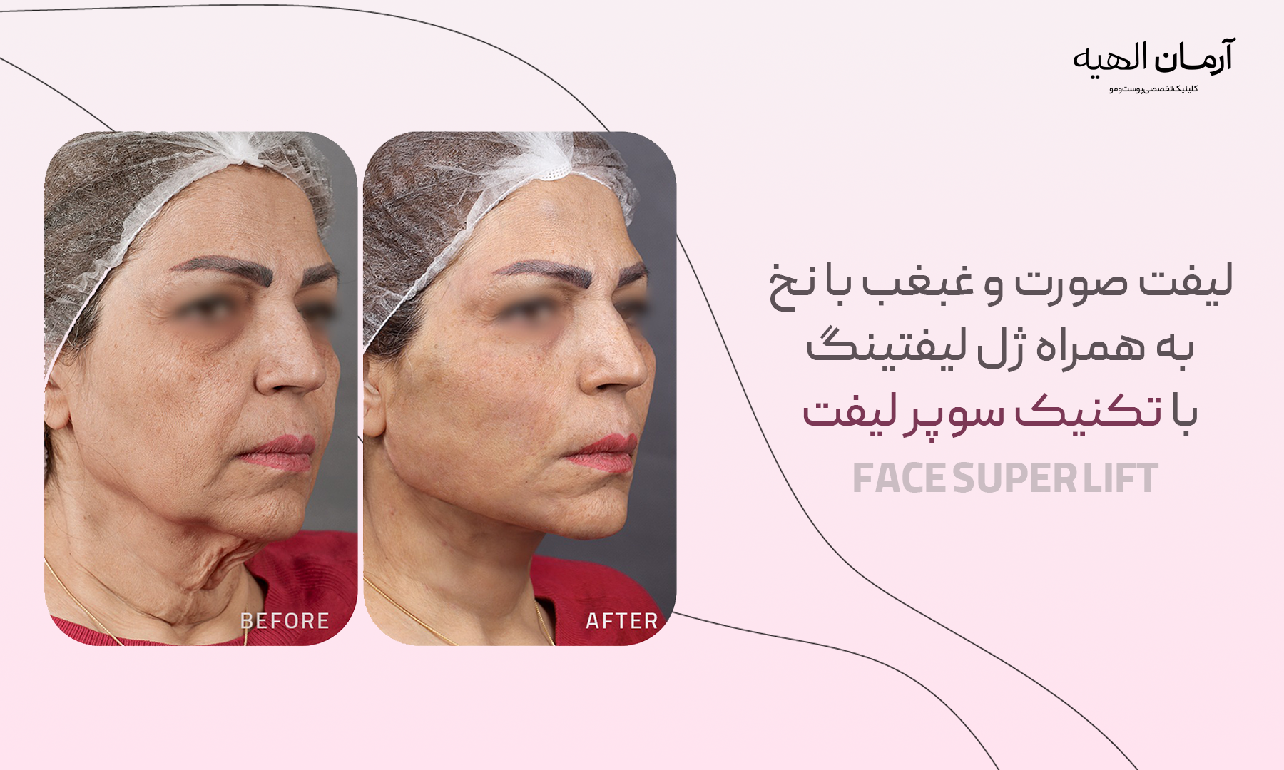 لیفت صورت و غبغب با نخ