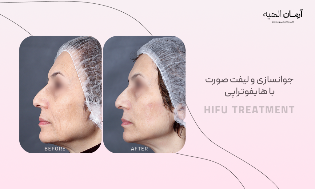 جوانسازی با هایفوتراپی در کلینیک تخصصی آرمان الهیه
