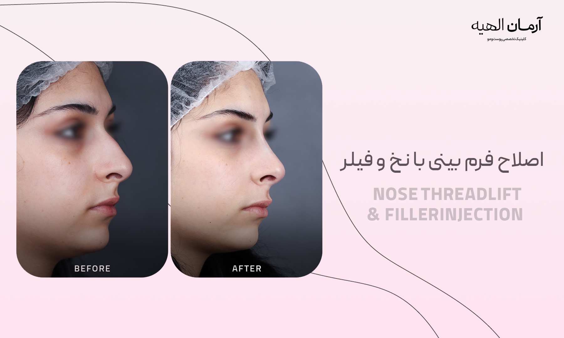 تزریق ژل بینی