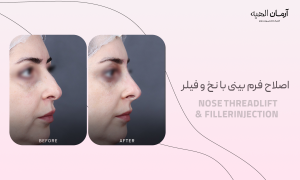 تزریق ژل بینی 
در کلینیک تخصصی آرمان الهیه