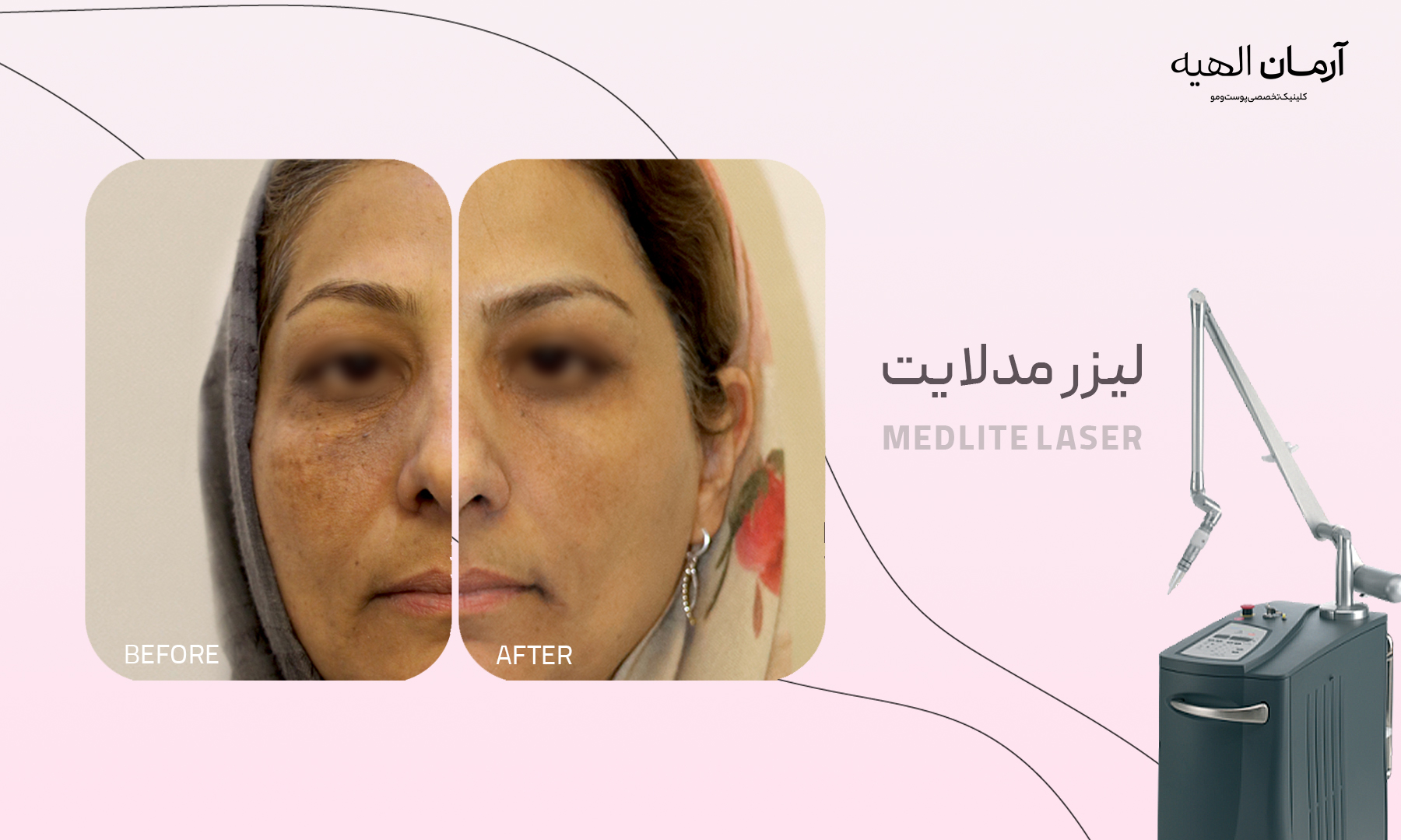 دستگاه لیزر مدلایت