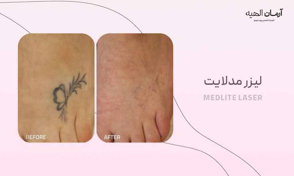 پاک کردن تاتو با لیزر مدلایت
در کلینیک تخصصی آرمان الهیه