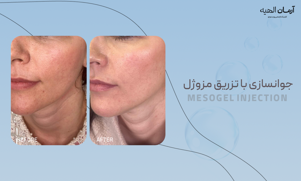 جوانسازی و آبرسانی با تزریق مزوژل
در کلینیک تخصصی آرمان الهیه