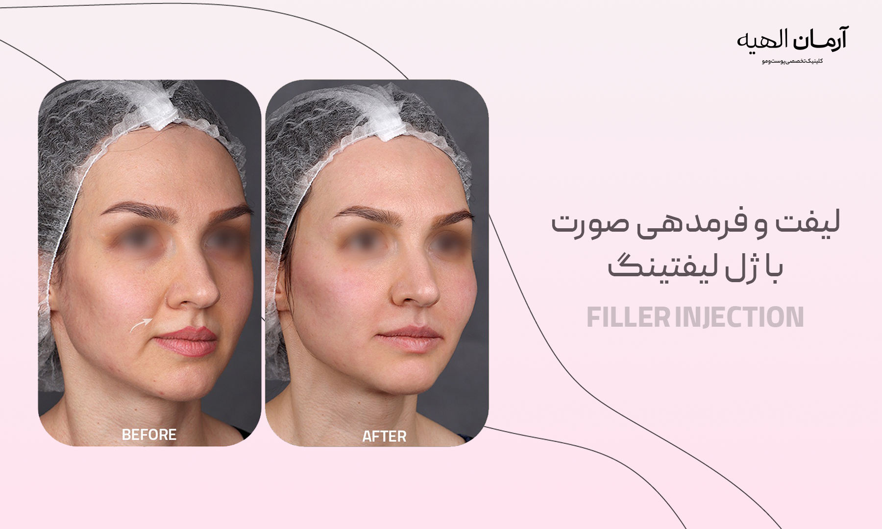 ژل لیفتینگ چیست؟