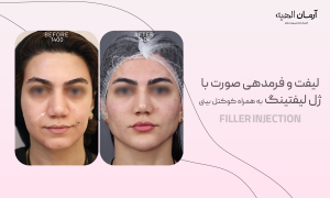 تزریق ژل لیفتینگ
در کلینیک تخصصی آرمان الهیه