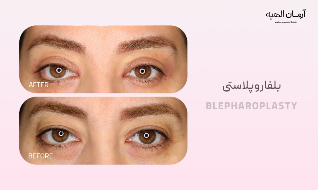 درمان افتادگی پلک با جراحی بلفاروپلاستی در کلینیک تخصصی آرمان الهیه