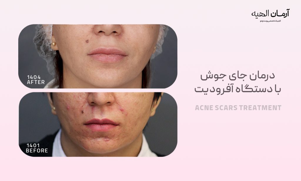 بهترین درمان جای جوش با دستگاه کلینیک تخصصی آرمان الهیه