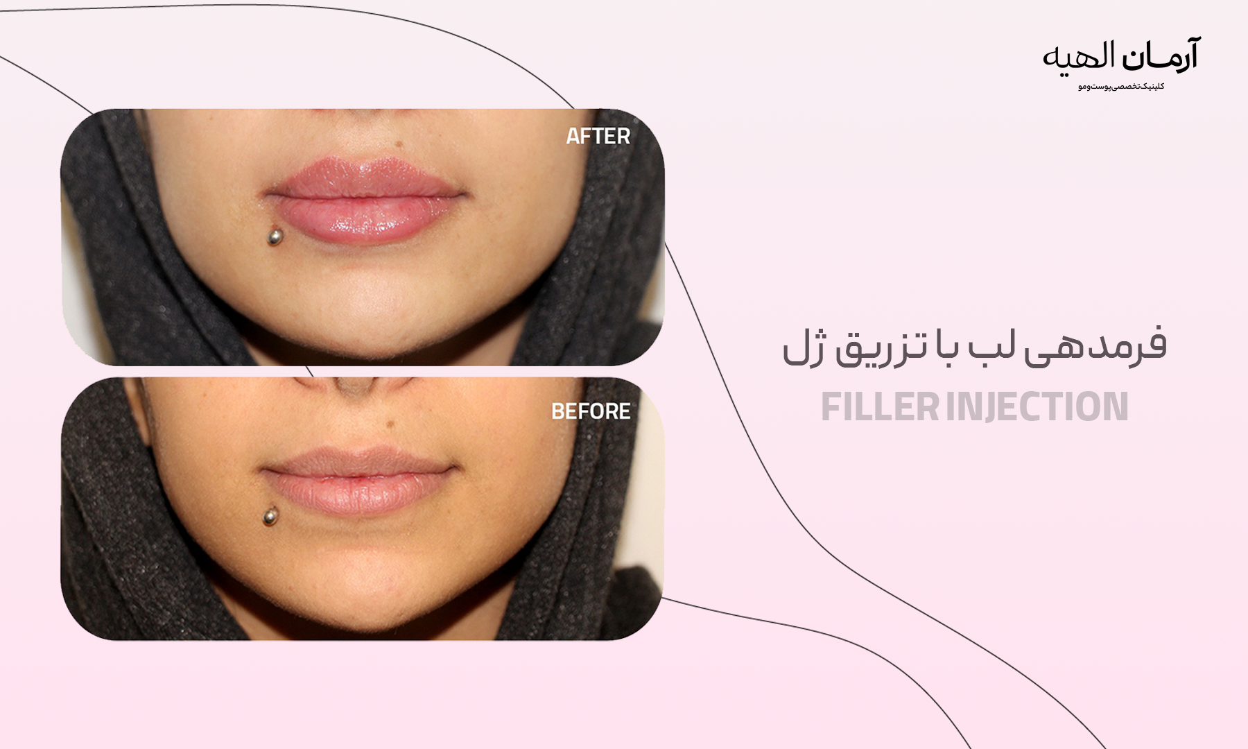 تزریق ژل لب