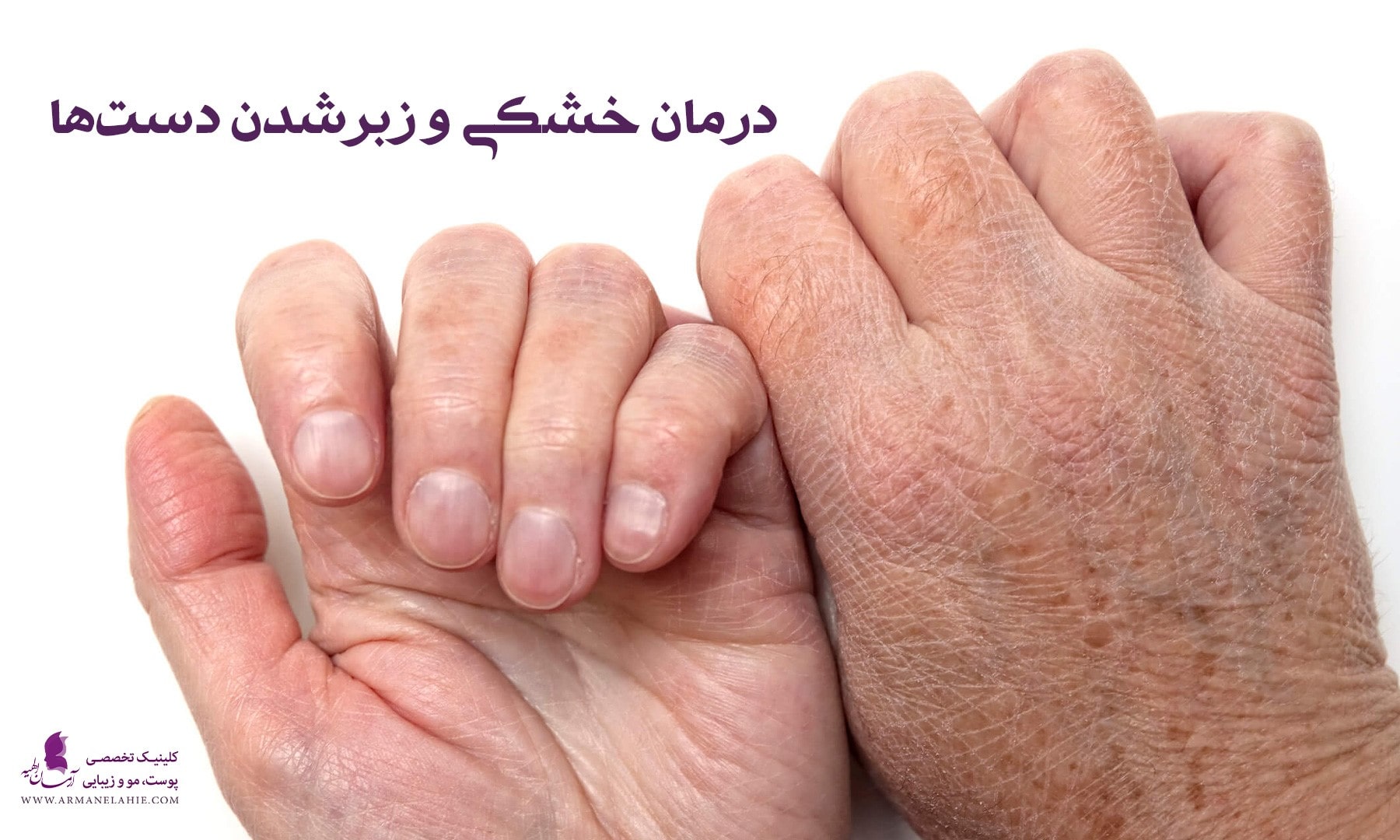 روش رفع خشکی و زبری پوست دست