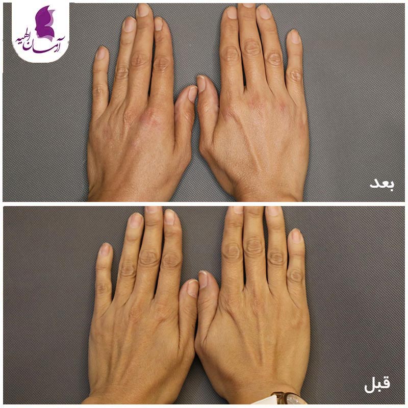 بهبود پوست دست