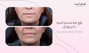 تزریق ژل خط خنده و خط اندوه
در کلینیک تخصصی آرمان الهیه