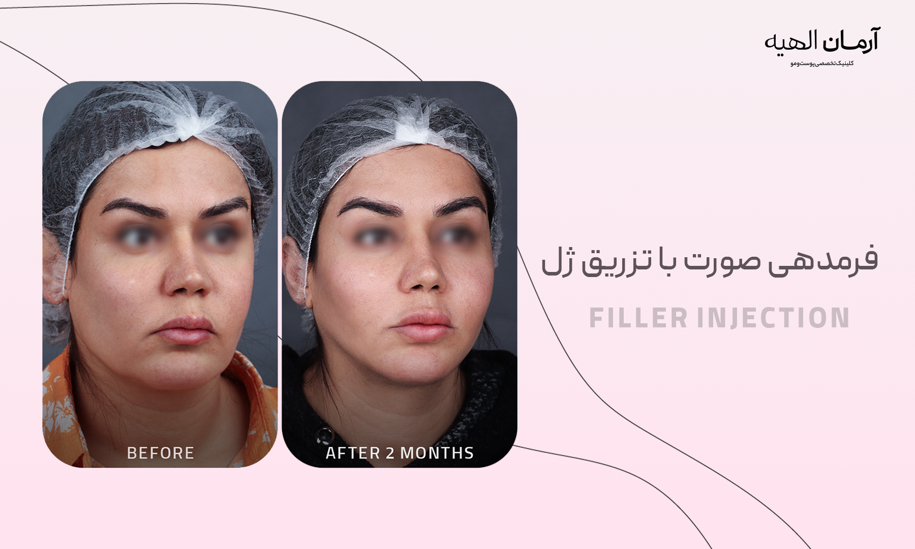 تزریق ژل گونه