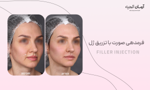تزریق ژل گونه
در کلینیک تخصصی آرمان الهیه